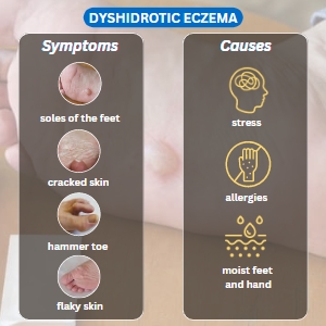 Dyshidrotic eczema symptoms and causes