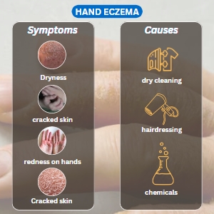 hand eczema symptoms and causes