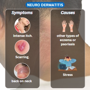 Neurodermatitis symptoms and causes