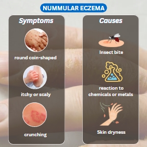 nummular eczema symptoms and causes