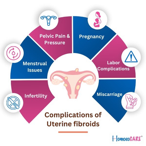 A medical diagram showing the potential complications of uterine fibroids, including pelvic pain and pressure, menstrual issues, infertility, and pregnancy complications like miscarriage and fibroid degeneration.
