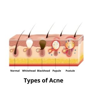 type of acne
