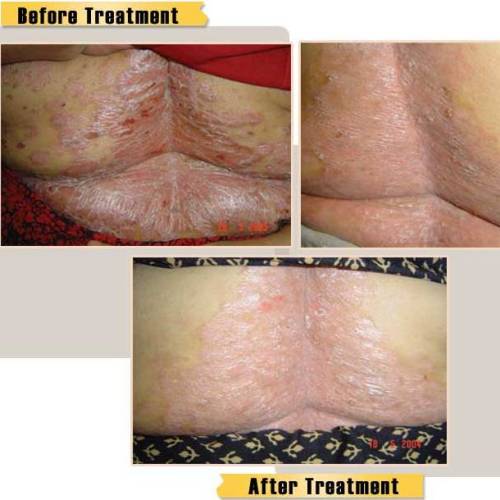 Psoriasis homeopathy treatment