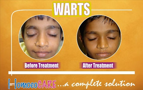 Warts homeopathic treatment case 1