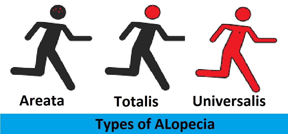 types of alopecia Homeopathic treatment of alopecia
