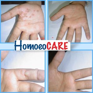homeopathic treatment for warts