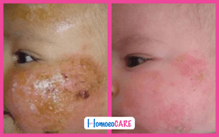  before and after ATOPIC DERMATITS treatment