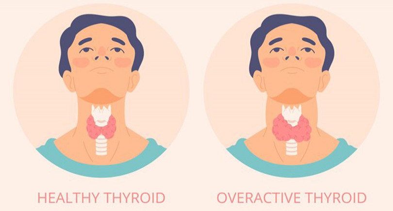 Weight Loss and Hypothyroidism: 5 Tips to Make it Possible