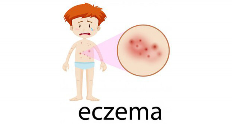 type of eczema