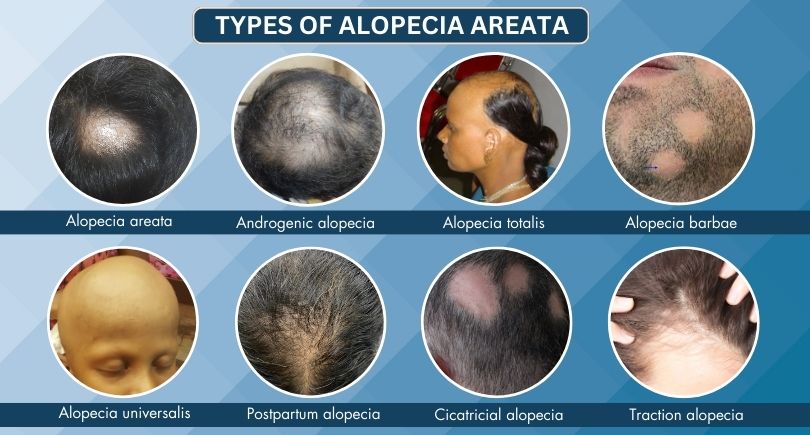 Types of Alopecia Image