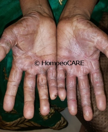 Homoeopathic Treatment for Palmoplantar Psoriasis 