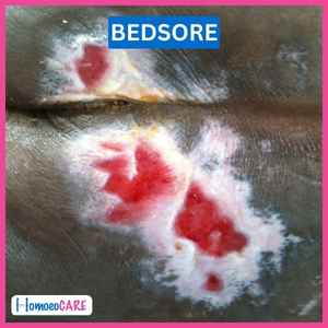 Bedsores Patient Image Before Homeopathic Treatment