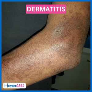 Infective Dermatitis After Homeopathy Treatment