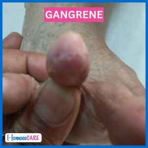 Gangrene After Homeopathy Treatment