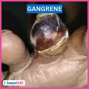 Gangrene image