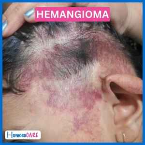 after homeopathic treatment in hemangioma