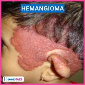 before homeopathic treatment in hemangioma