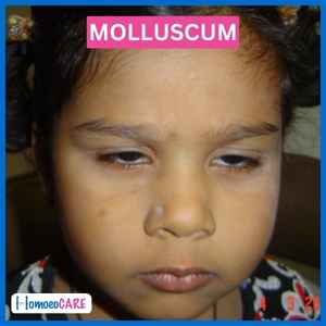 after homeopathic treatment for molluscum