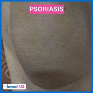 Psoriasis Knees after treatment result