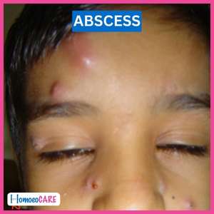 Homoeopathic Treatment for Recurrent Abscess 