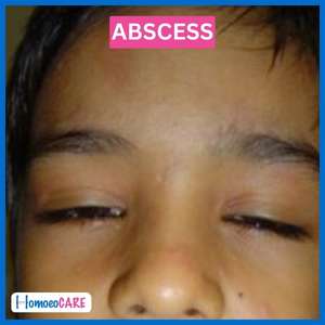 Recurrent Abscess After Homeopathy Treatment