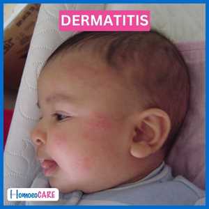 After homeopathy treatment, the child's atopic dermatitis has improved significantly.