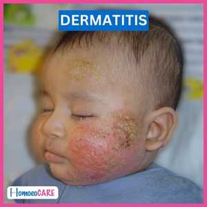 Child Suffering From Atopic Dermatitis
