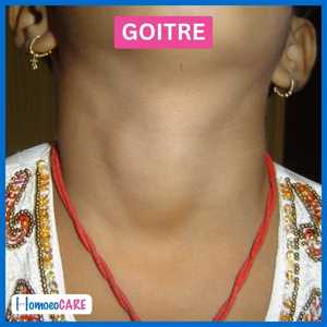 goitre treatment after image