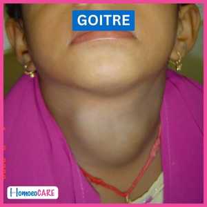 goitre treatment before image