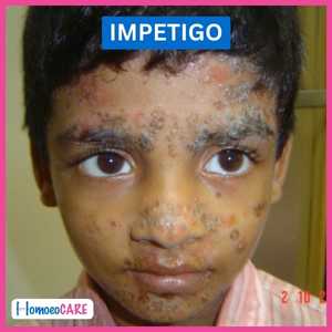 Homeopathy treatment of impetigo in children before image