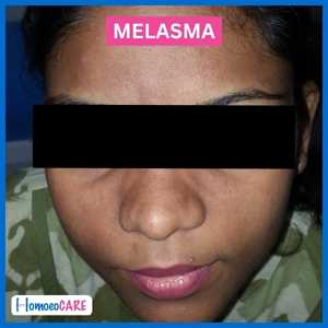 Melasma After Homeopathy Treatment Image
