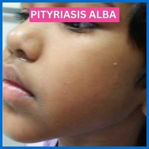  Pityriasis After Homeopathy Treatment