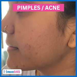 Pimples and acne are removed after homeopathic treatment
