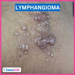 Lymphangioma Disease