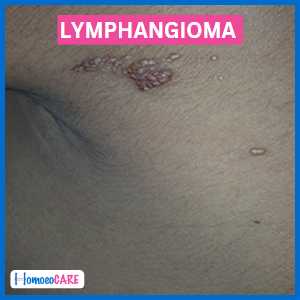 Lymphangioma Disease After Homeopathy Treatment