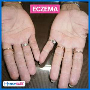 eczema in hand homeopathic treatment