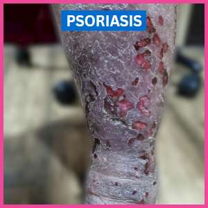 before psoriasis foot treatment