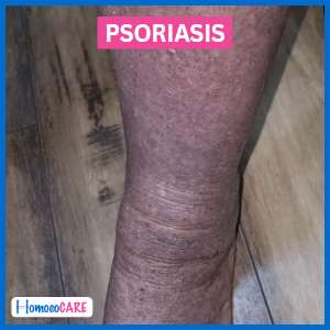 after psoriasis foot treatment