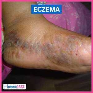 before eczema foot treatment
