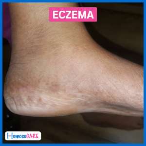 after eczema foot treatment