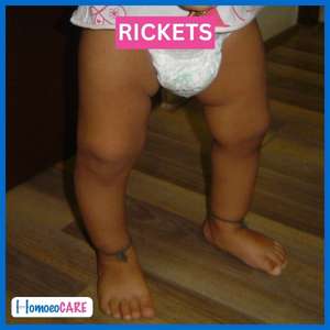 Rickets After Homeopathy Treatment
