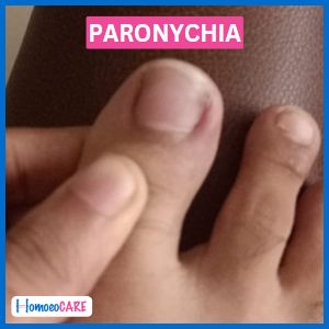 after paronychia homeopathic treatment