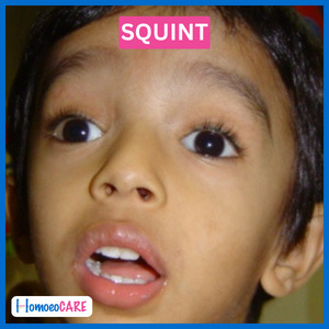  Squint After Homeopathic Treatment