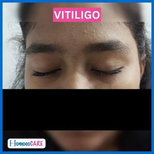  Vitiligo After Homeopathic Treatment