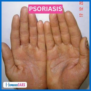 Psoriasis After Homeopathic Treatment