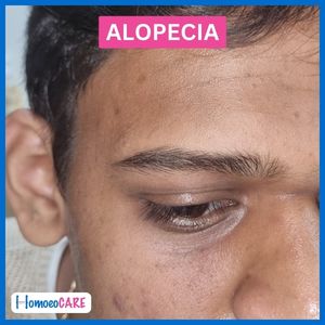 Homeopathy Treatment for Alopecia Totalis