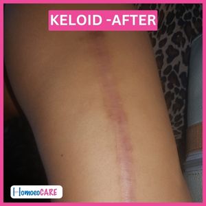 Homeopathic treatment For Keloid