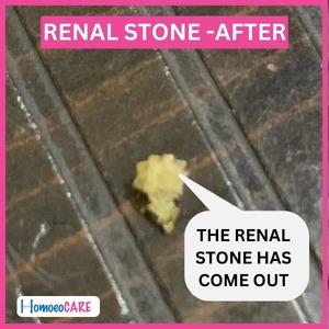 Homeopathic treatment for kidney stone: A real stone expelled, showcasing effectiveness of holistic approach in treatment