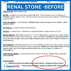 Medical report displaying renal stone diagnosis, indicating potential kidney health concerns. Diagnostic findings visible
