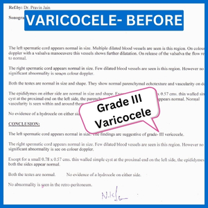 The report of the person with varicocele shows that they are suffering from grade 3